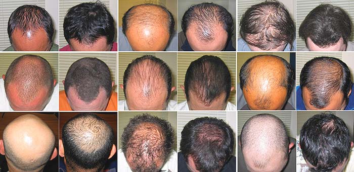 vitamins help regrow hair